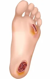 Imagen del artículo TERAPIA CON OXIGENACION HIPERBARICA