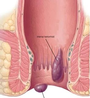 Imagen del artículo HEMORROIDES