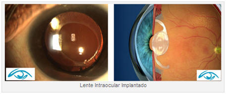 LENTE INTRAOCULAR