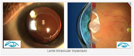 LENTE INTRAOCULAR