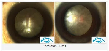 Imagen del artículo CIRUGIA DE CATARATAS
