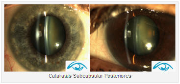 catarata ojos