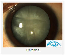 SINTOMAS DE CATARATA OJOS