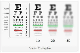 CIRUGIA LASER DE OJOS