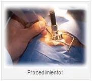 CIRUGIA LASER DE OJOS PASO 1