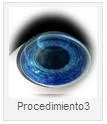 CIRUGIA LASER DE OJO PASO 3