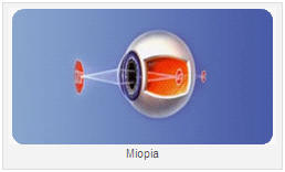MIOPIA