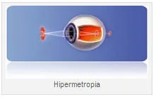 HIPERMETROPIA