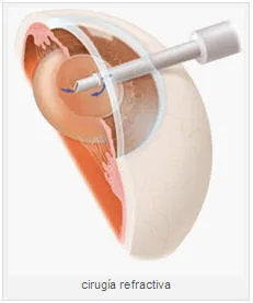 CIRUGIA REFRACTIVA