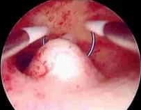 eliminación de pólipos endometriales con histeroscopía
