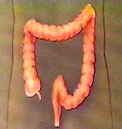 prevención del cáncer de colon