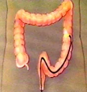 prevención del cáncer de colon