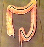 prevención del cáncer de colon