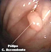 Imagen del artículo QUE SON LOS Pólipos ?