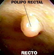 QUE SON LOS Pólipos ?