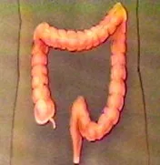 prevención del cáncer de colon