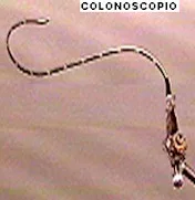 prevención del cáncer de colon