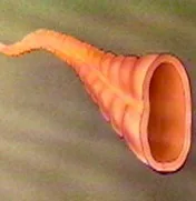 prevención del cáncer de colon