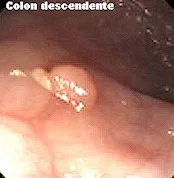 QUE SON LOS Pólipos ?