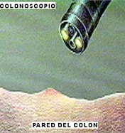 prevención del cáncer de colon