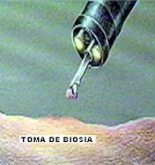 prevención del cáncer de colon