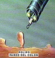 prevención del cáncer de colon