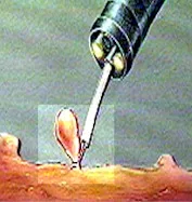 prevención del cáncer de colon