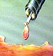 prevención del cáncer de colon