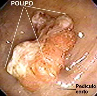 QUE SON LOS Pólipos ?