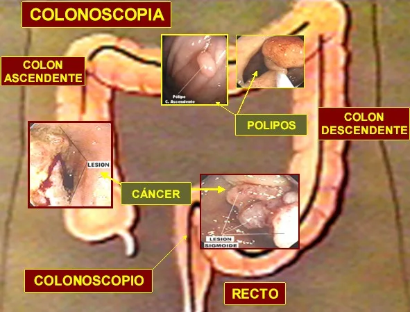 QUE SON LOS Pólipos ?
