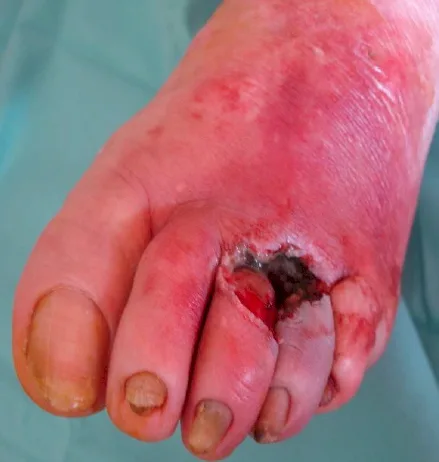 Tratamiento ulcera pie diabetico