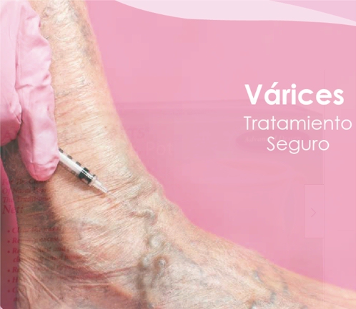 varices