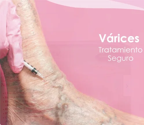 Imagen del artículo Tratamiento de várices