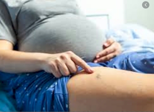 varices y embarazo