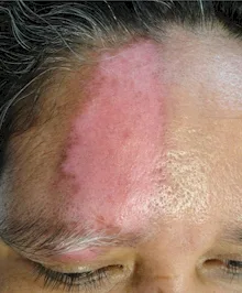 Imagen del artículo APLICACIÓN intradérmica DE PLASMA RICO EN PLAquíETAS más PROCaída COMO TERAPIA EN VITILIGO