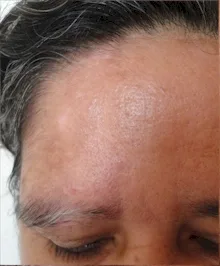 VITILIGO - Nuevo tratamiento con plaquetas en Ecuador