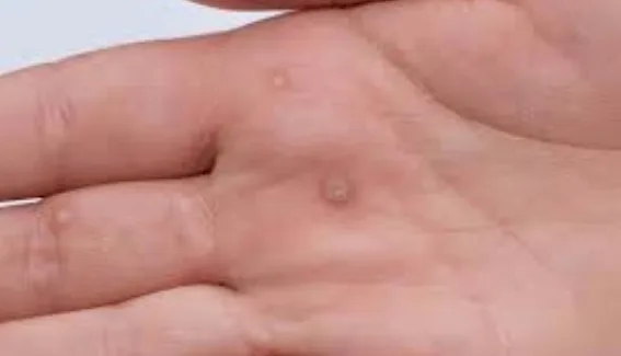 Imagen del artículo VIRUS DEL PAPILOMA HUMANO VPH